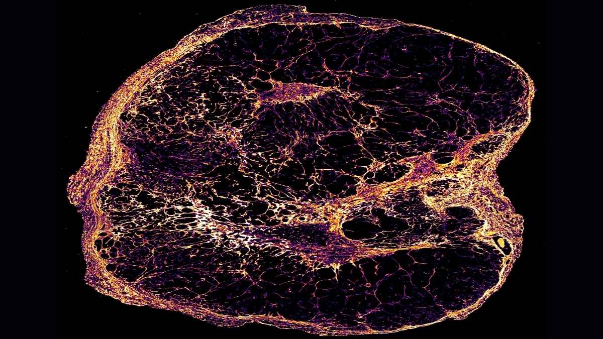 Slow-growing breast cancer cells lead to long term relapse Free
